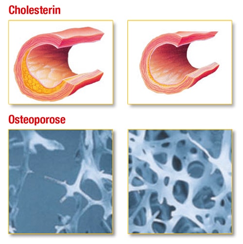 Cholesterin - Osteoporose
