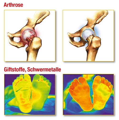 Arthrose - Giftstoffe, Schwermetalle